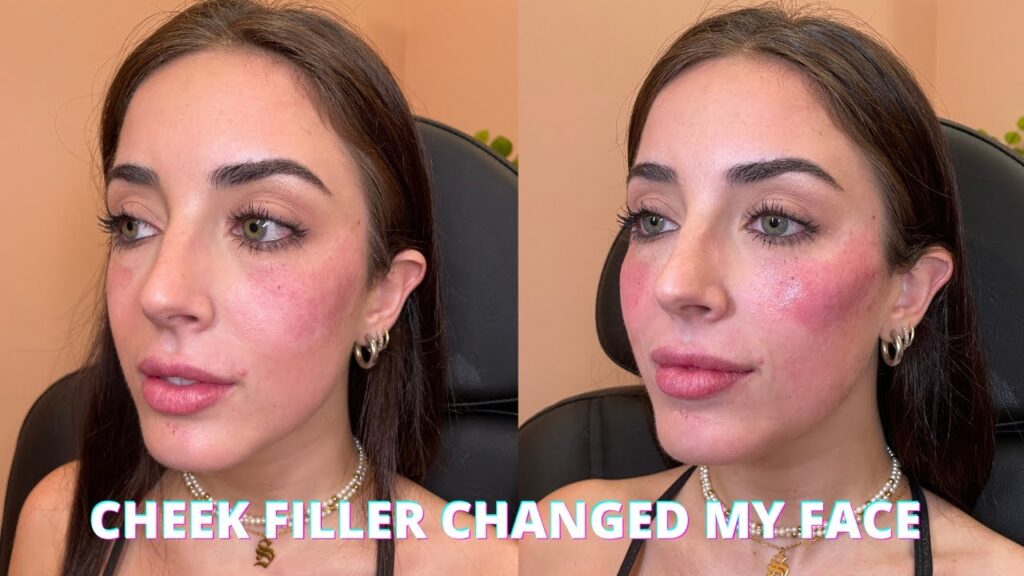 4ml cheek filler
